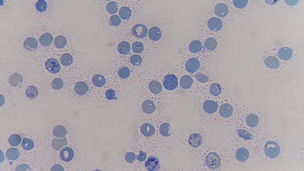 被癌症“盯”上的人，手脚可能有哪些表现？癌细胞最怕8件事！